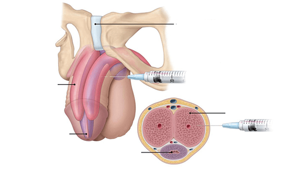 Inject your own fat tissue to achieve penis thickness