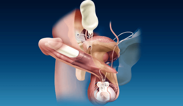 Silicone and Gel Thickness Fillers